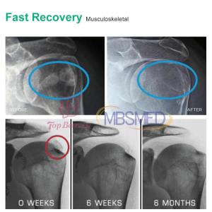 Buy cheap Difference between Focused and Radial Shockwave Therapy Machine Maximum Intensity Concentrated Superficially from wholesalers