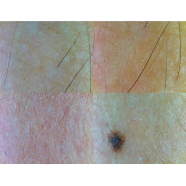 Portable Wireless Digital Skin Analyzer Telemedicine Diagnosis Device With Polarize Light