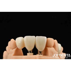 Buy cheap Close Friends Of Bones Foundation Of Beauty Zirconia Implants Aesthetic Assurance from wholesalers