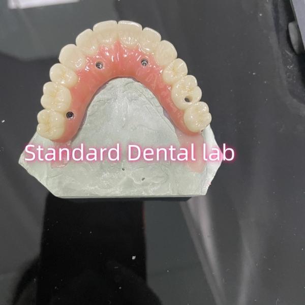 All On Four Six Ivoclar Zirconia Implant Bridge TItanium Bar With Pink Gum
