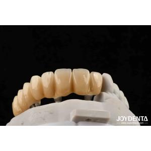 Close Friends Of Bones Foundation Of Beauty Zirconia Implants Aesthetically