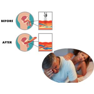 200mj Electromagnetic Pain Relief Eswt Ems Shockwave Machine