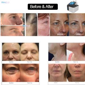 Electrical Plasma Skin Tightening Machine Customized For Scar Removal