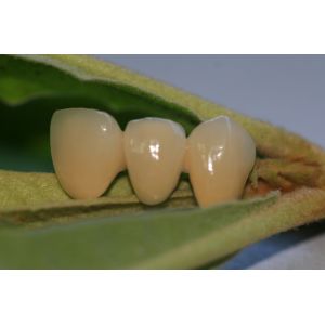 Buy cheap ISO13485 Good Biocompatibility PFM Non Precious Dental Crown from wholesalers