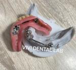 Buy cheap Retentive Ivoclar Full Acrylic Denture Teeth With Attachments from wholesalers