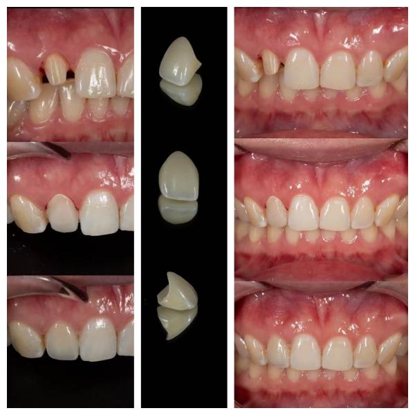 Quality Zirconia dentures that imitate natural teeth for sale