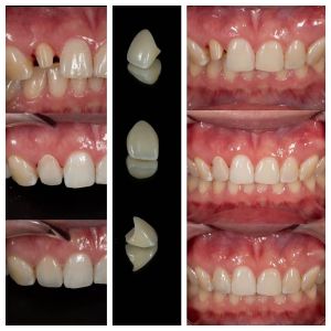 Buy cheap Zirconia Dental Crowns Fabrication Lab | Precision Crown Outsourcing - Joydentalab from wholesalers