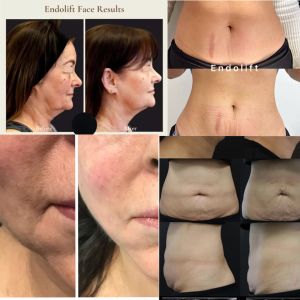 Medical Endolift Spider Vein Laser Machine / EVLT Laser Machine