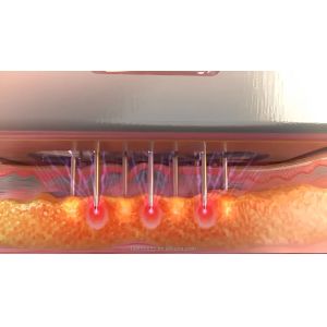 Buy cheap Safe And Precise Fractional RF Microneedling Machine For Skin Rejuvenation And Tightening from wholesalers