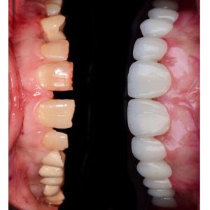 Buy cheap 43%-57% Translucency 700-1200 MPa Bending Strength YUCERA Dental 98mm Open System CAD/CAM 4D Pro Multilayer Zirconia Block from wholesalers