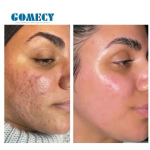 GOMECY Microneedling Radiofrequency Machine , Microneedle Fractional RF System