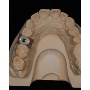 Screw Cement Retained Implant For Long-Lasting Dental Implants With 5-Year