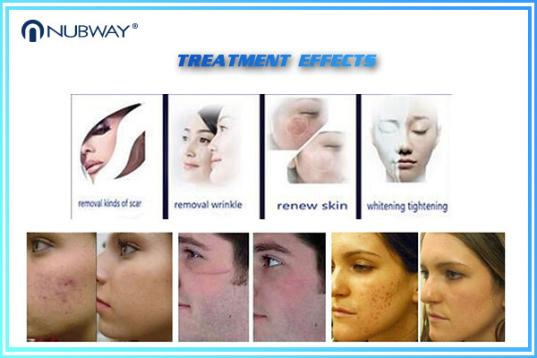 Buy cheap Factory Price scar wrinkles removal skin resurfacing fractional co2 laser machine from wholesalers