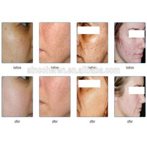 Professional IPL Skin Rejuvenation Machine , Intense Pulsed Light Hair Removal