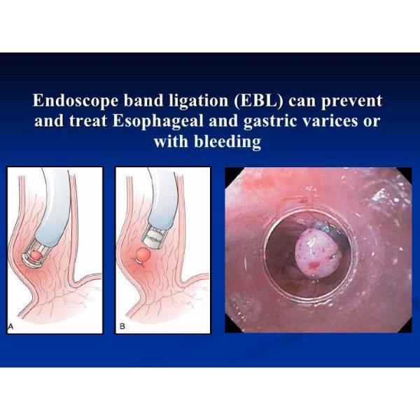 Endoscopic Rubber Band Ligator 10mm Endoscopy Accessory