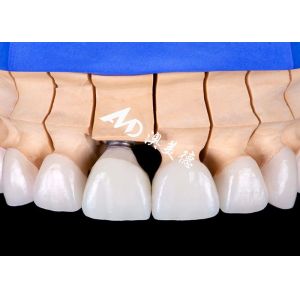 Buy cheap Functional Aesthetic Dental Implant Crown Bridge – Precision and Durability from wholesalers