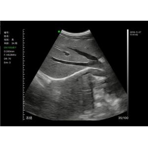 Multi Frequency Convex Or Linear Probe Handheld Ultrasound Scanner Supported IOS