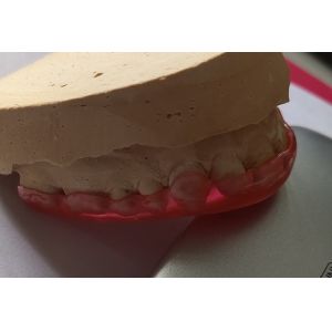 Buy cheap Hard Acrylic Maxillary Arch Stabilization Guard For Bruxism from wholesalers