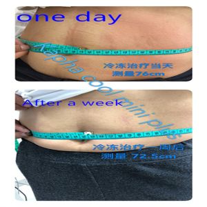 Buy cheap 80Kpa Cool Sculpting Cryolipolysis Fat Freezing Machine from wholesalers