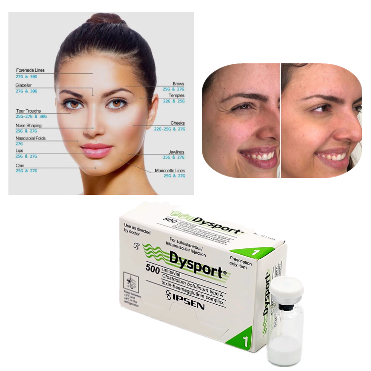 Dysport 500U Botulinum Toxin Type A for Wrinkle Treatment