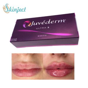281ML Hyaluronic Acid Lip Filler Juvederm Ultra3 Dermal