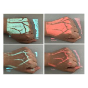 Venipucture Drawing Blood Varicosity Treatment Micro-plastic Surgery Vein