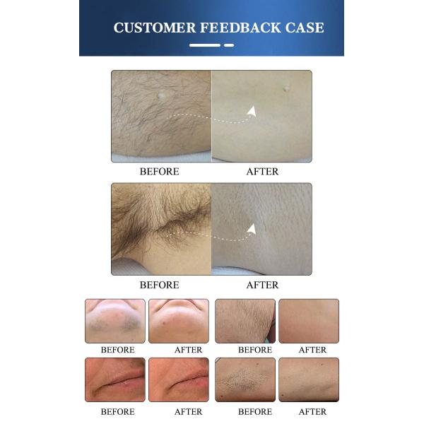 Newest Diode Laser 808 nm Alma Soprano ICE Diode Laser Hair Removal Machine Price