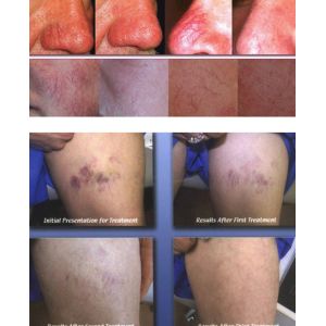 Buy cheap spider vein removal machine with best treatment effect from wholesalers