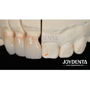 Painless Procedure BOPT Dental Technique for Accurate Tooth Preparation