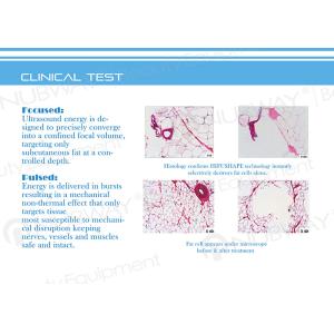 2015 newest beauty slimming machine Slimming Fat Cellulite Reduction hifu