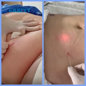 Buy cheap Endolift Laser Machine Double Chin and Lipolysis/Liposuction Fat Melting with 980nm 1470nm 635nm Wavelengths Treatment from wholesalers