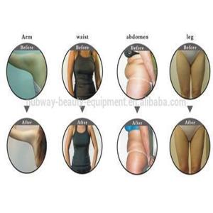 Buy cheap 2016 Newest 500W Output 150W Input power Liposonix Slimming Machine from wholesalers