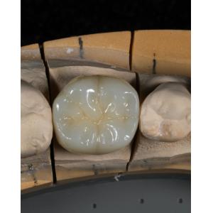 Full Contour Zirconia Crown Quick Turnaround for Precise and Aesthetic Fit in 1