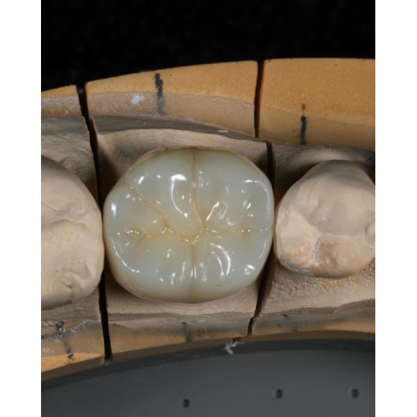 Full Contour Zirconia Crown Quick Turnaround for Precise and Aesthetic Fit in 1