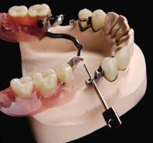 Adjustable Mk1 Dental Attachment Water Resistant With Stainless Steel