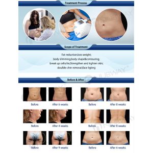 Five handles good result Cryolipolysis Slimming machine