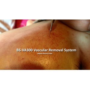 High Frequency Red Blood Vascular Removal Machine With Pulse / Continuous Work