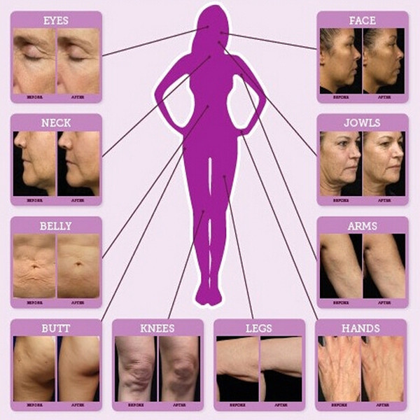 2016 best wrinkle removal anti aging skin rejuvenation rf fractional microneedle