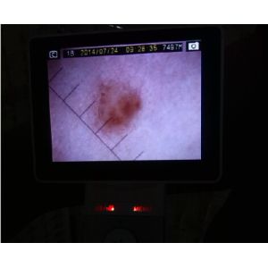 Rechargeable Portable Otoscope Ophthalmoscope Dermatoscope With SD Card Output