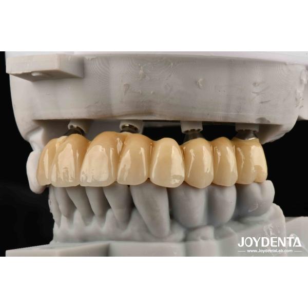 Close Friends Of Bones Foundation Of Beauty Zirconia Implants Aesthetically