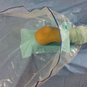 Buy cheap Medical Disposable Surgical Knee Arthroscopy Drape Pack / Kit from wholesalers