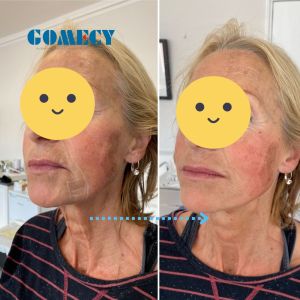 Professional Endolifting Laser Machine for Lipolysis and Body Contouring with