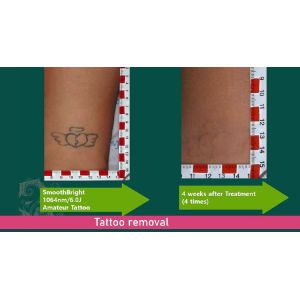 Buy cheap Facial Rejuvenation Picosecond Laser Machine 1064nm 532nm 755nm Wavelength from wholesalers