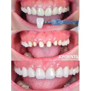 Buy cheap Zirconia Dental Crown Case Study | Global Lab Outsourcing - Joydentalab from wholesalers