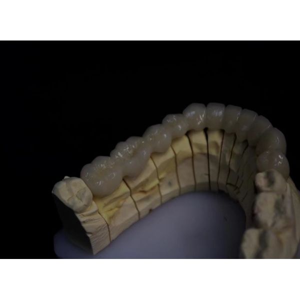 Quality Layered Porcelain Fused Zirconia for sale