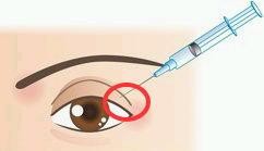 Buy cheap Non Cross Linked Medical Ophthalmic Sodium Hyaluronate Gel hyaluronic acid product