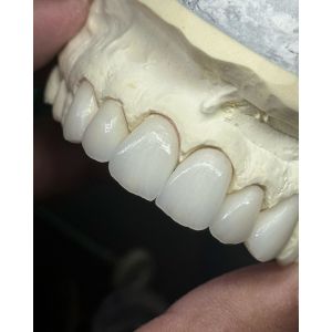 Buy cheap Transluency Layered Zirconia Crown for Optimal Functionality and Natural Aesthetics from wholesalers