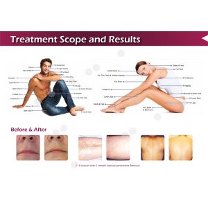 Buy cheap hot sale high speed big spot forever free 808nm color Diode Laser Hair Removal Machine for face from wholesalers