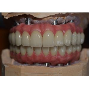 Buy cheap Precision-Crafted Dental Implant Crowns for Comfort & Confidence from wholesalers