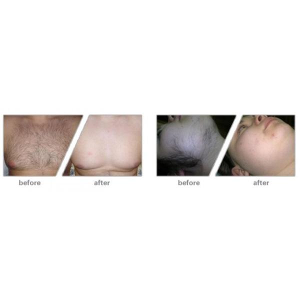 808nm Permanent Hair Removal Laser Machine , Unwanted Hair Removal Machine